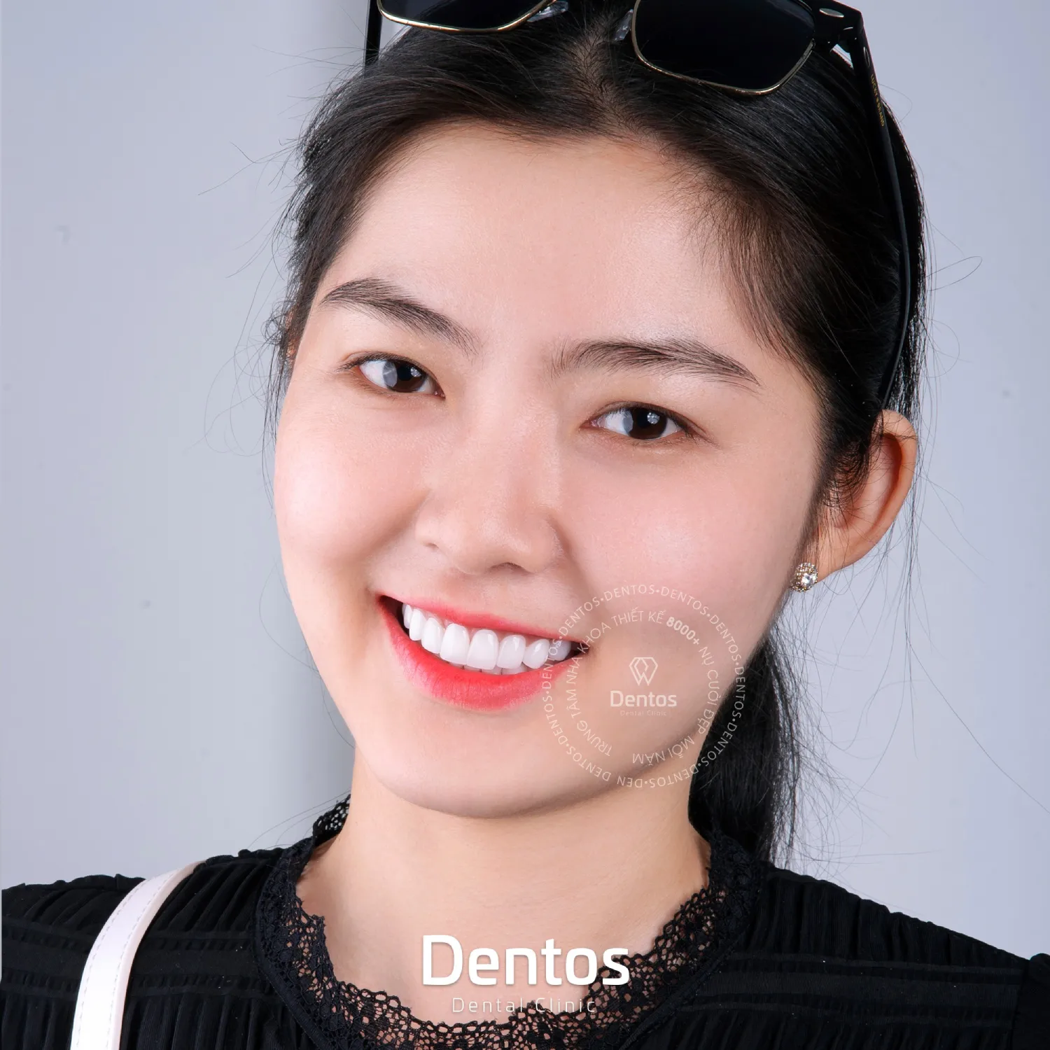 Răng sứ Cercon HT mang lại vẻ đẹp tự nhiên và sống động